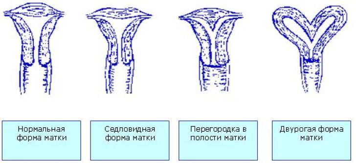Заболевания матки: профилактика и лечение