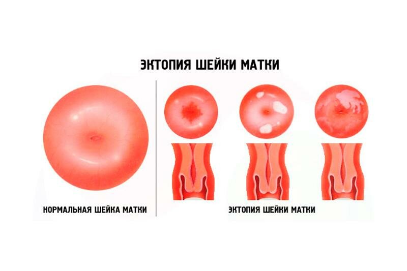 Заболевания влагалищной части шейки матки