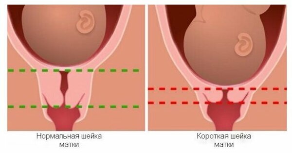 Существует несколько стадий ИЦН