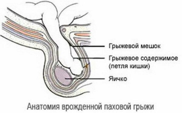 Пупочная и паховая грыжи у детей