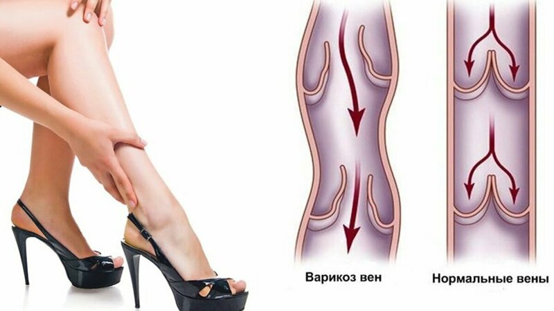 И снова он — варикоз