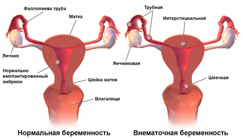 Что происходит при внематочной беременности?
